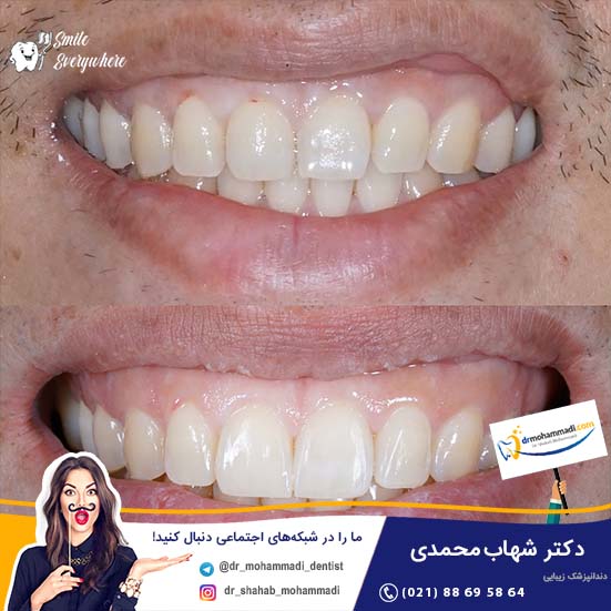 آیا شما کاندید مناسبی برای لیفت لثه هستید؟ - کلینیک دندانپزشکی دکتر شهاب محمدی